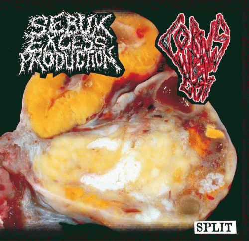 Sebum Excess Production : Sebum Excess Production - Corpus Luteum Cyst